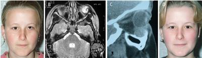 Management of Orbital and Periorbital Venous Malformation